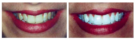 teeth whitening in Hendersonville TN